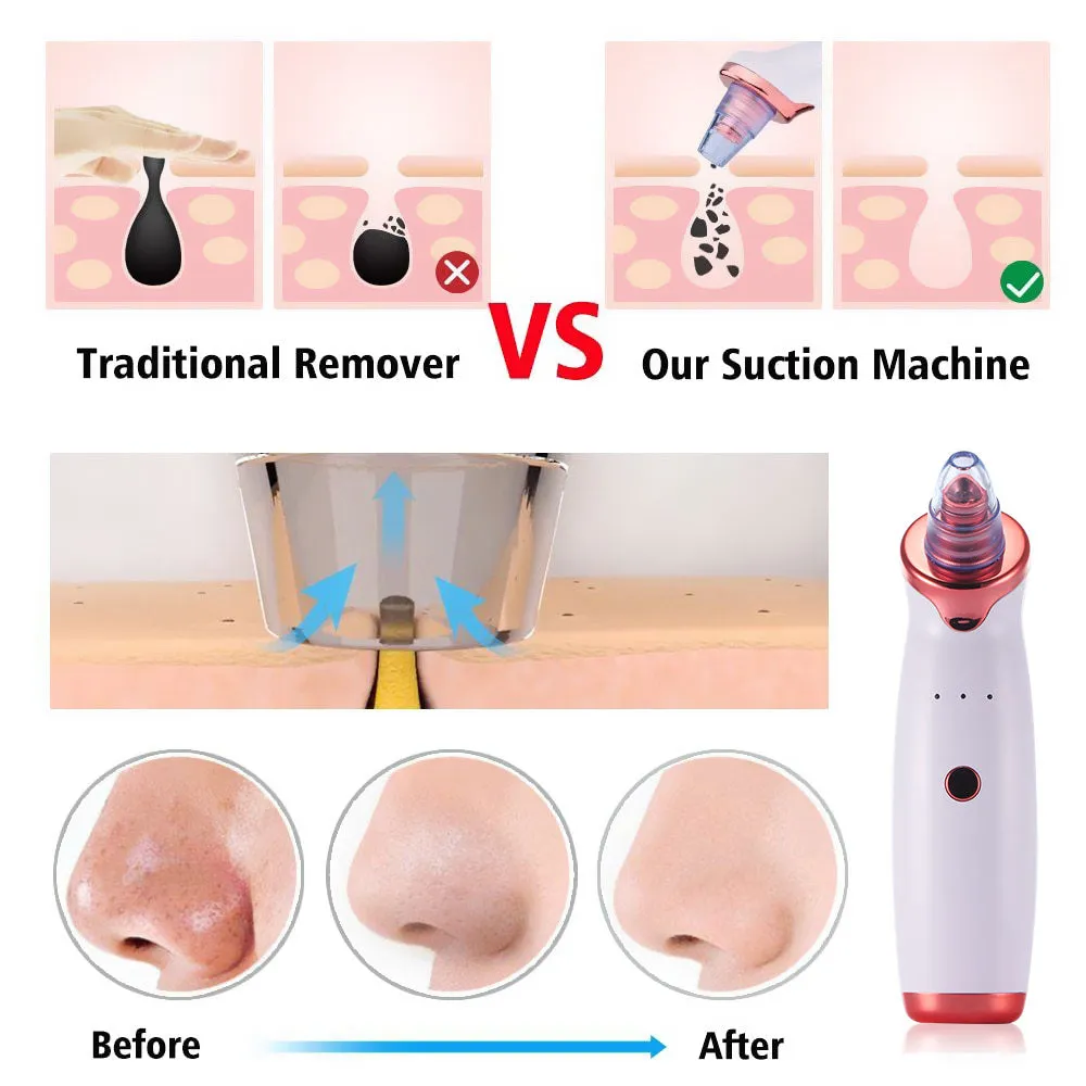 Electric Acne Remover Blackhead Remover Apparatus